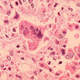 Illustration for article titled An American Has Died From Measles for the First Time Since 2003